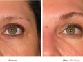 ultherapy before after v4