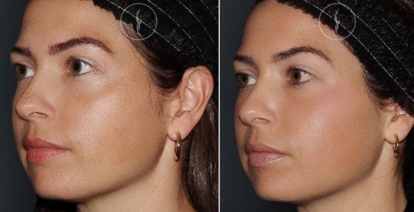 halo before after v0